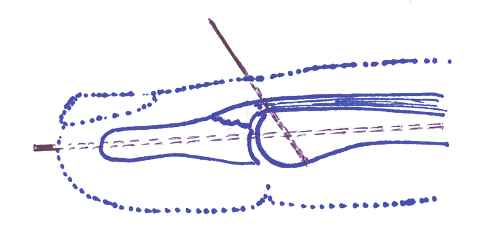 Technika extenčního bloku. Při plné flexi v distálním interfalangeálním článku je nejprve zaveden perkutánně Kirschnerův drát přes koncovou část dorzální aponeurózy do středního článku.
Následně je provedena dorzální distálního článku a přes apex prstu je zaveden druhý Kirschnerův drát do článku středního.