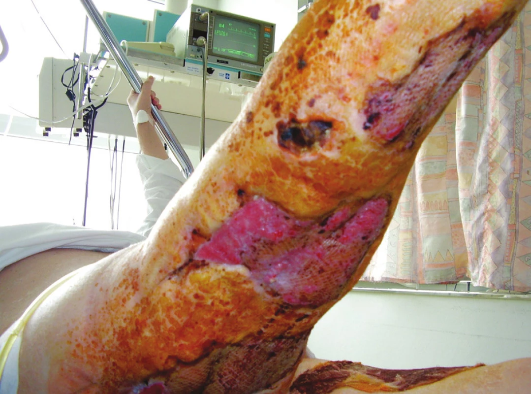 Ranné plochy na pravé dolní končetině po autotransplantaci DE štěpy
Fig. 7. Wound areas of the right lower limb after a dermoepidermal autotransplantation