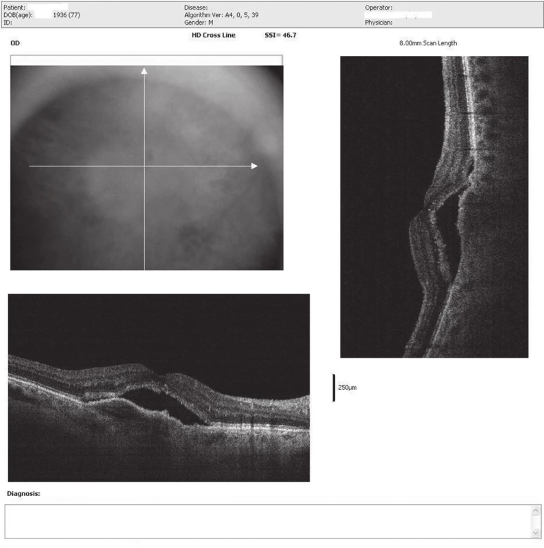 OCT snímok (HD cross-line) pravého oka. Subfoveolárne výrazná serózna ablácia neuroretiny s edémom aj s abláciou RPE