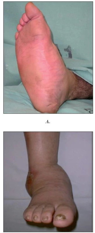 Charcotova osteoarthropatie
A. Aktivní stádium
B. Pokročilé stadium s postižením talokrurálního kloubu