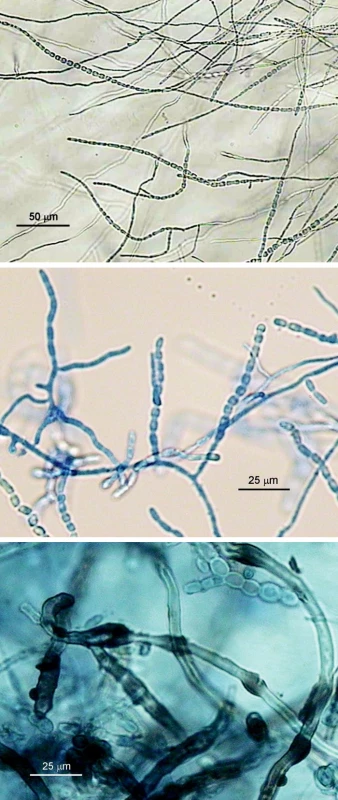 a, b, c. Onychocola canadensis, mikroskopická morfológia; a) hýfy a dlhé retiazky súdkovitých artrokonídií (mikrokultúra, vodný agar, 10 dní, 25 °C), b) dtto, 2-3-týždňová kultúra, preparát v laktofenole s metylovou modrou, c) retiazky 1- a 2-bunkových artrokonídií a hnedé „nodózne“ hýfy (preparát v laktofenole zo starej kultúry na SAB agare) (foto A.V.)
Fig. 4 a, b, c. Onychocola canadensis, micromorphology; a) hyphae and long chains of barrel-shaped arthroconidia (microculture, aqueous agar, 10 days, 25 °C), b) see a), 2-3-week culture, methylene blue-lactophenol mount, c) chains of single- and double-cell arthroconidia and brown nodular hyphae (lactophenol mount from previous Sabouraud agar culture) (photo A.V.)