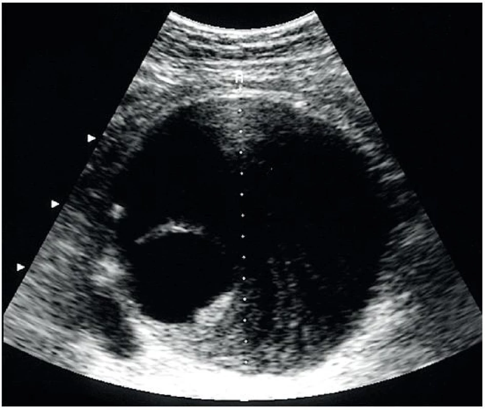 Velké aneurysma břišní aorty, částečně vyplněné trombem a s dobře viditelným průchodným lumen