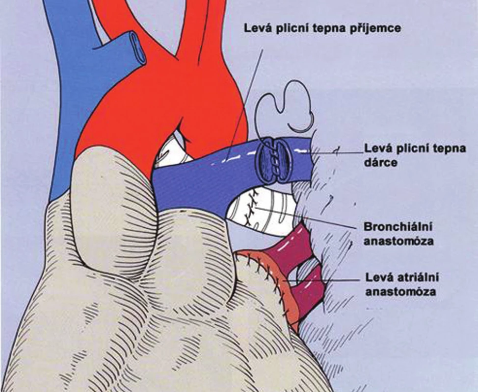 Technika transplantace plic
Fig. 3. Lung tansplantation technique