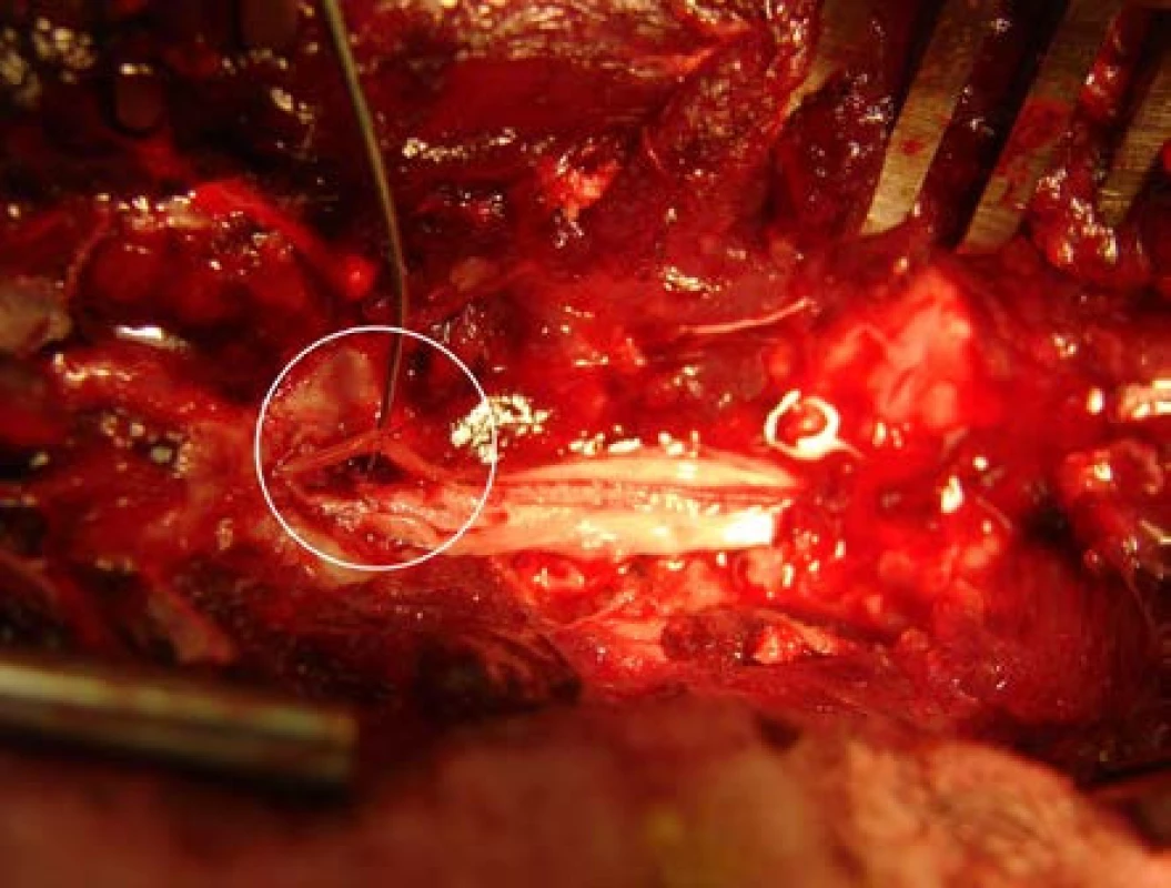 Peroperační foto – sutura míšního kořene
Fig. 4. Intraoperative photo – spinal root suture