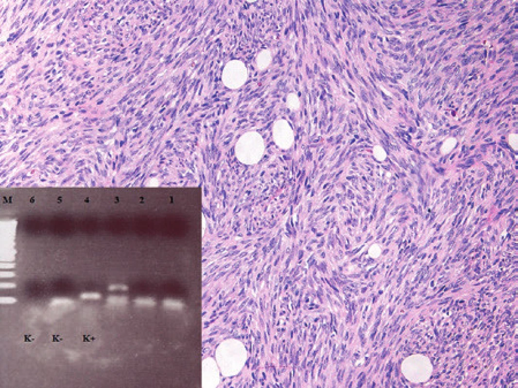 Kazuistika 3. Dermatofibrosarcoma protuberans. Fascikulárně uspořádané vřetenobuněčné oblasti nádoru infiltrujícího kůži a podkožní tukovou tkáň. Barveno hematoxylinem a eosinem (původní zvětšení 100x). Vložený obrázek: Agarózový gel s detekcí fúzního genu Col1A1/PDGFb, který je produktem translokace t(17;22). Zprava: 1. negativní pacient, 2. negativní pacient, 3. pacient s dermatofibrosarcoma protuberans, 4. pozitivní kontrola RT-PCR, 5. negativní kontrola RT, 6. negativní kontrola PCR, M 100 bp velikostní marker.