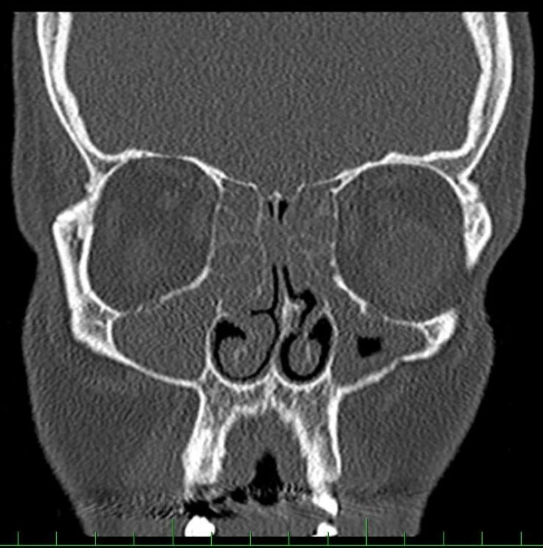 CT vedlejších nosních dutin, koronární snímek. Typický obraz u pacienta s nosní polypózou. Vpravo kompletně zatřená maxilární dutina, přední etmoidy a oblast ostiomeatální jednotky, vlevo kompletně zastřená oblast ostiomeatální jednotky, přední etmoidy a částečně zastřená maxilární dutina.