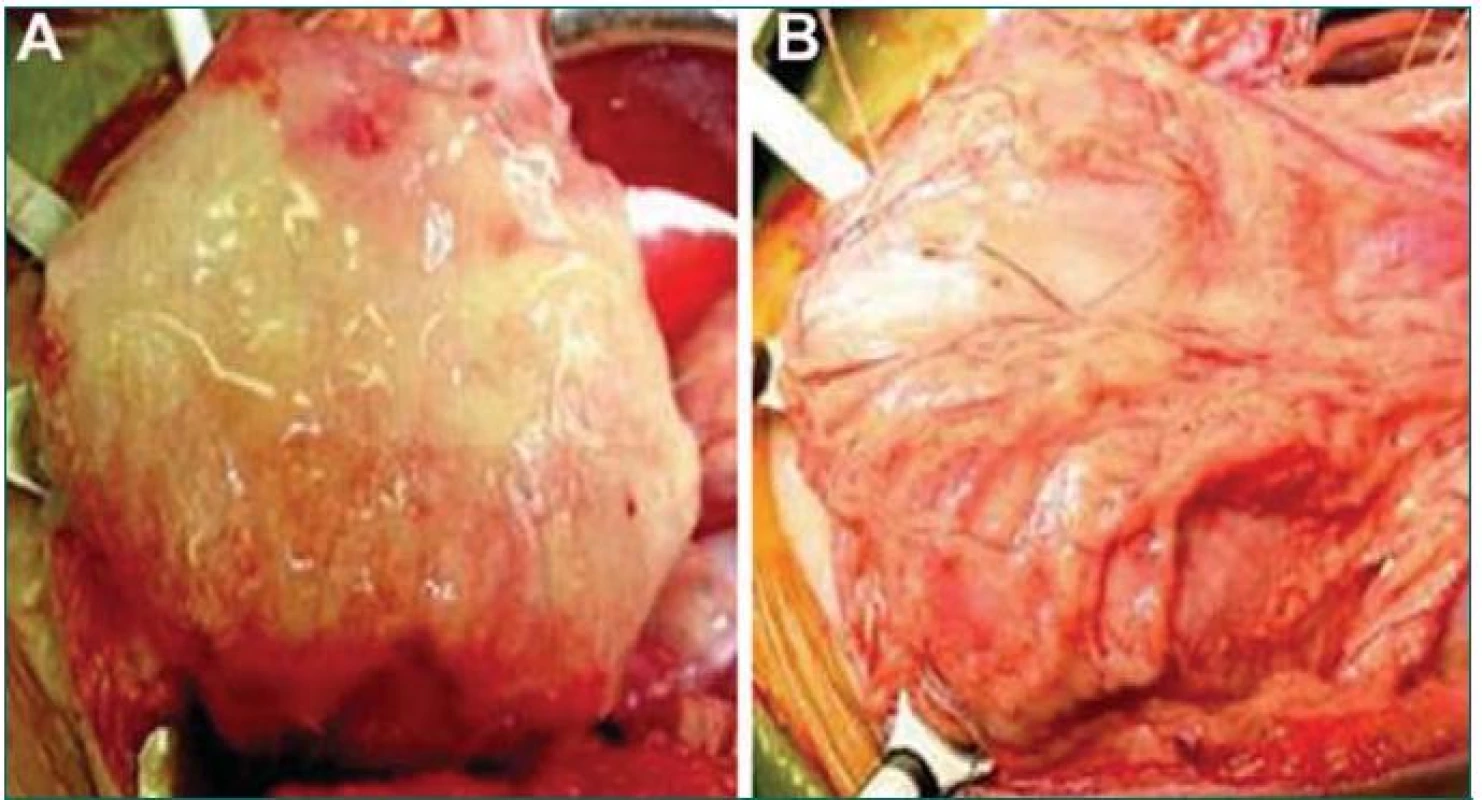 Konstrukce lidského močového měchýře pomocí TE.
A. Měchýř je pomocí anastomózy fixován ke tkáni původního močového měchýře (pomocí pokračovací 4-0 polyglykolové sutury).
B. Implantovaný měchýř je pokryt vrstvou fibrinového lepidla a omenta.