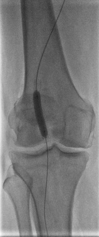 Dodilatácia implantovaného stentu
Fig. 2. Final dilation of the implanted stent