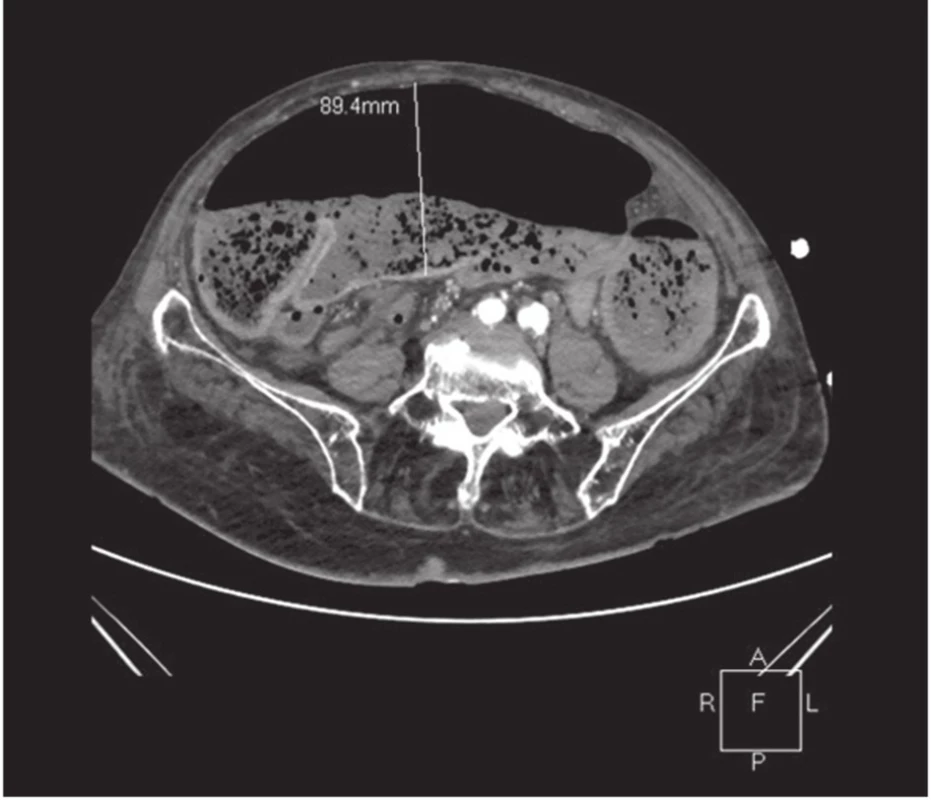 CT obraz ileu dilatovaný tračník s maximem až 9 cm,
Fig. 1: CT image of the ileus, colon dilated to a maximum of up to 9 cm