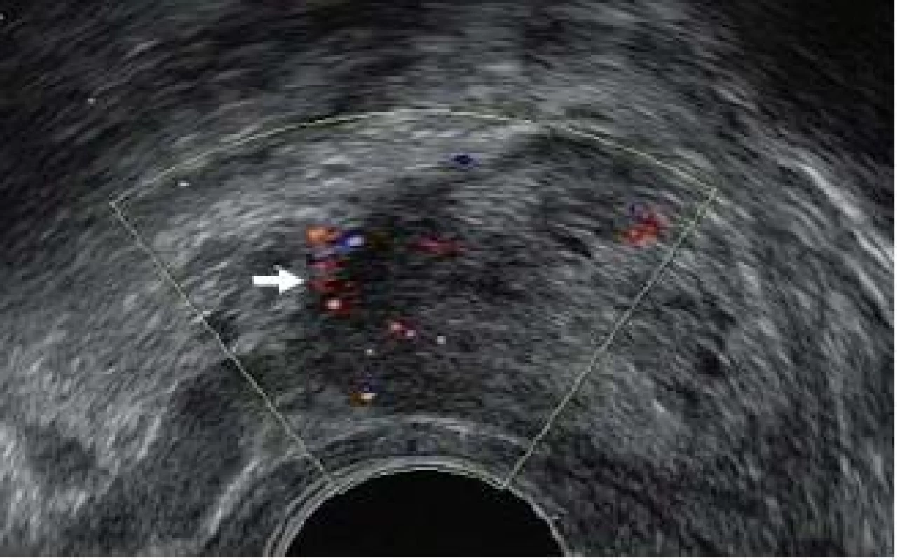 Zvýšený regionální průtok krve (bílá šipka) v důsledku karcinomu prostaty na barevném Dopplerovském ultrazvukovém vyšetření.