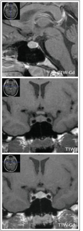 MRI nález objemnější hypofýzy s kraniálně konvexním vyklenutím, bez jasného ložiskového nálezu, u 32leté pacientky.