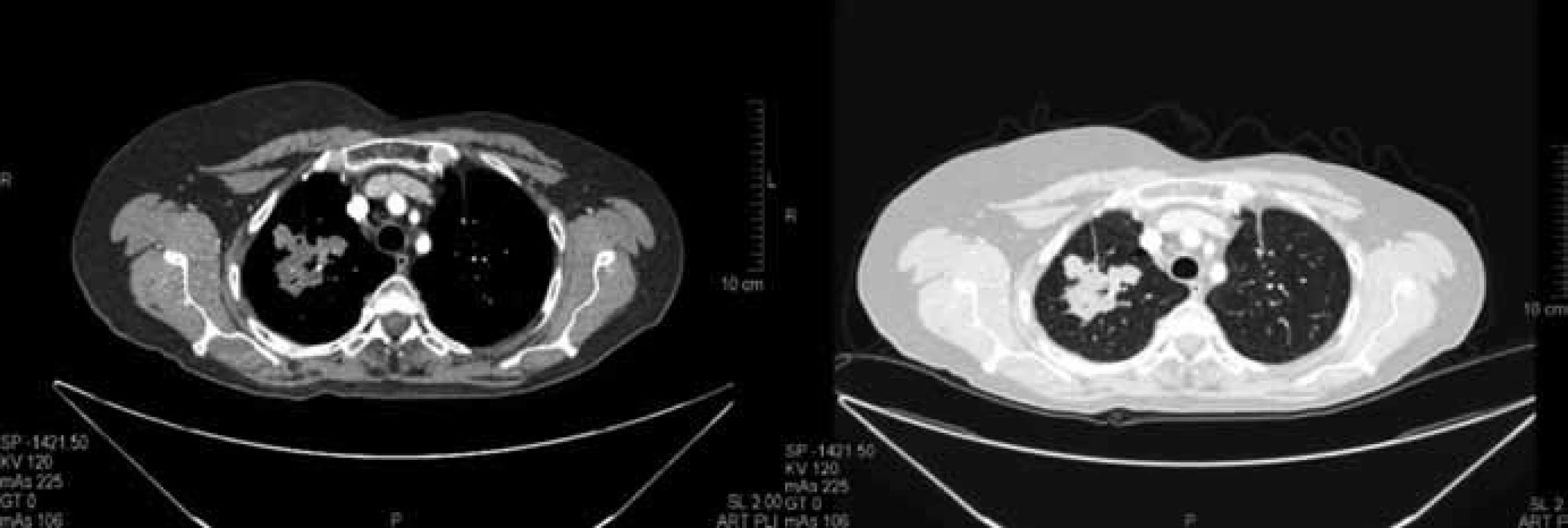 Vstupní CT vyšetření plic z prosince 2009 před zahájením terapie. Vstupně 2 cílové léze o součtu rozměrů dle RECIST 85 mm.