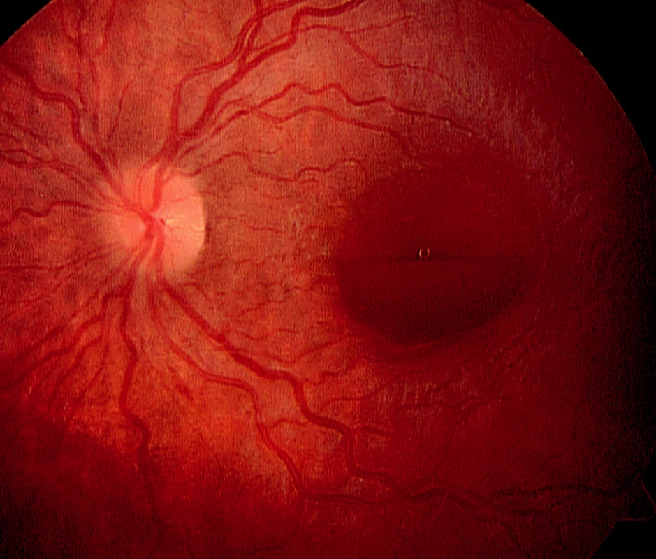 Leukémie u 10leté dívky, která se projevila preretinálním krvácením v oblasti makuly levého oka