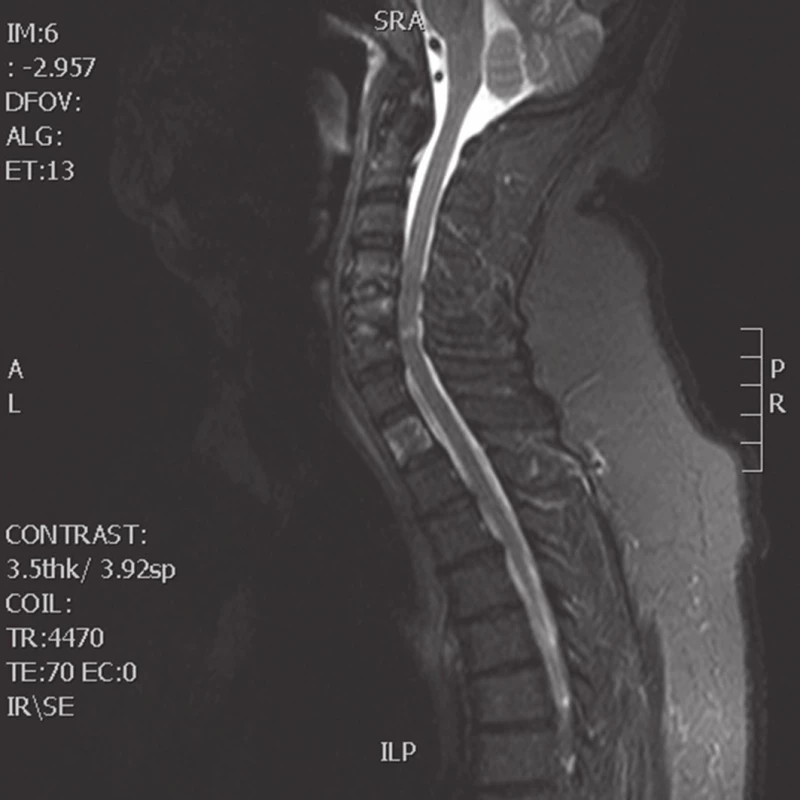 MRI krční páteře, sagitální, T2-vážený sken (Žena, 56 let, 3 měsíce po přední operaci C4−6, rozšíření předozadního rozměru páteřního kanálu na 9,2 mm, myelopatické změny míchy).
Fig. 4: MRI of cervical spine, T2-weighted sagital scan (Female patient, 56-year-old, three months after surgery at levels C4−6, enlargement of the anteroposterior cervical spinal canal distance to 9.2 mm, myelopathic changes)