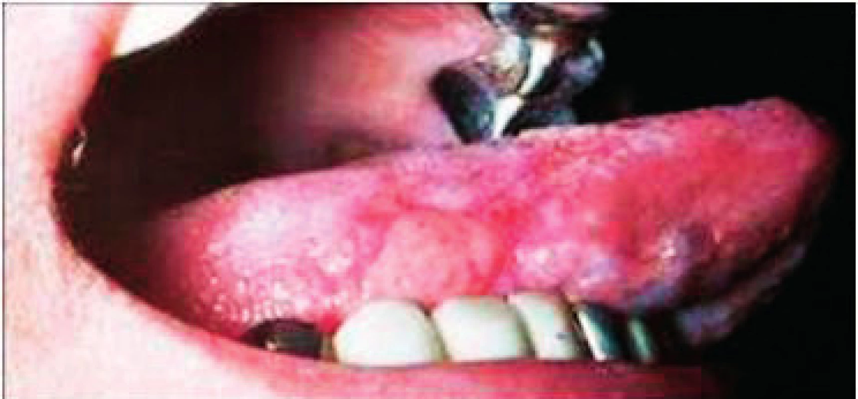 Glositis areata migrans. Prítomný je patologicky zmnožený povlak s erozívnymi políčkami. Stav je pri infekcii &lt;i&gt;Helikobakter pylori&lt;/i&gt;
