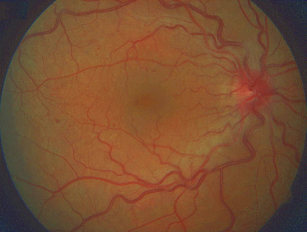 Stav po 1. roce léčby – přetrvává mírné překrvení terče zrakového nervu a dilatované, tortuózní vény, došlo k významnému ústupu retinálních hemorhagií, měkkých exsudátů i ME