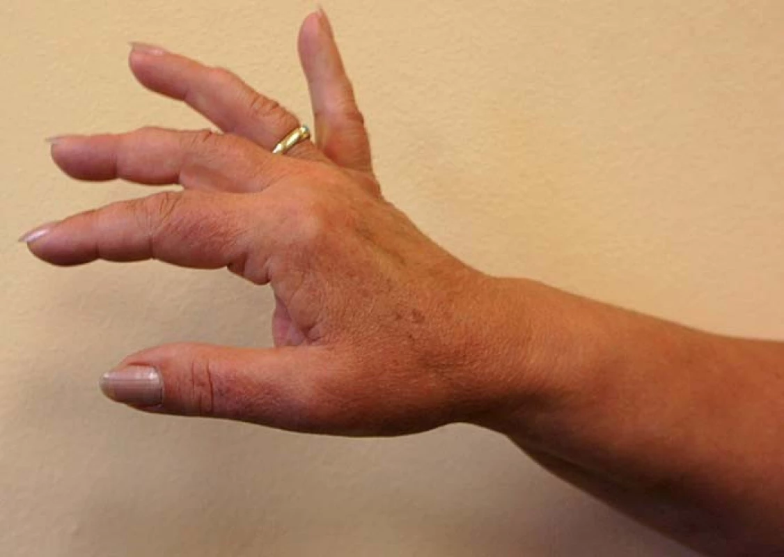 Pacientka 1.
Nález 12 měsíců po operaci – extenze zápěstí a MP kloubu IV. a V. prstu M4, u II. a III. prstu na M3 a u palce M2, ve 24 měsících nález stejný.