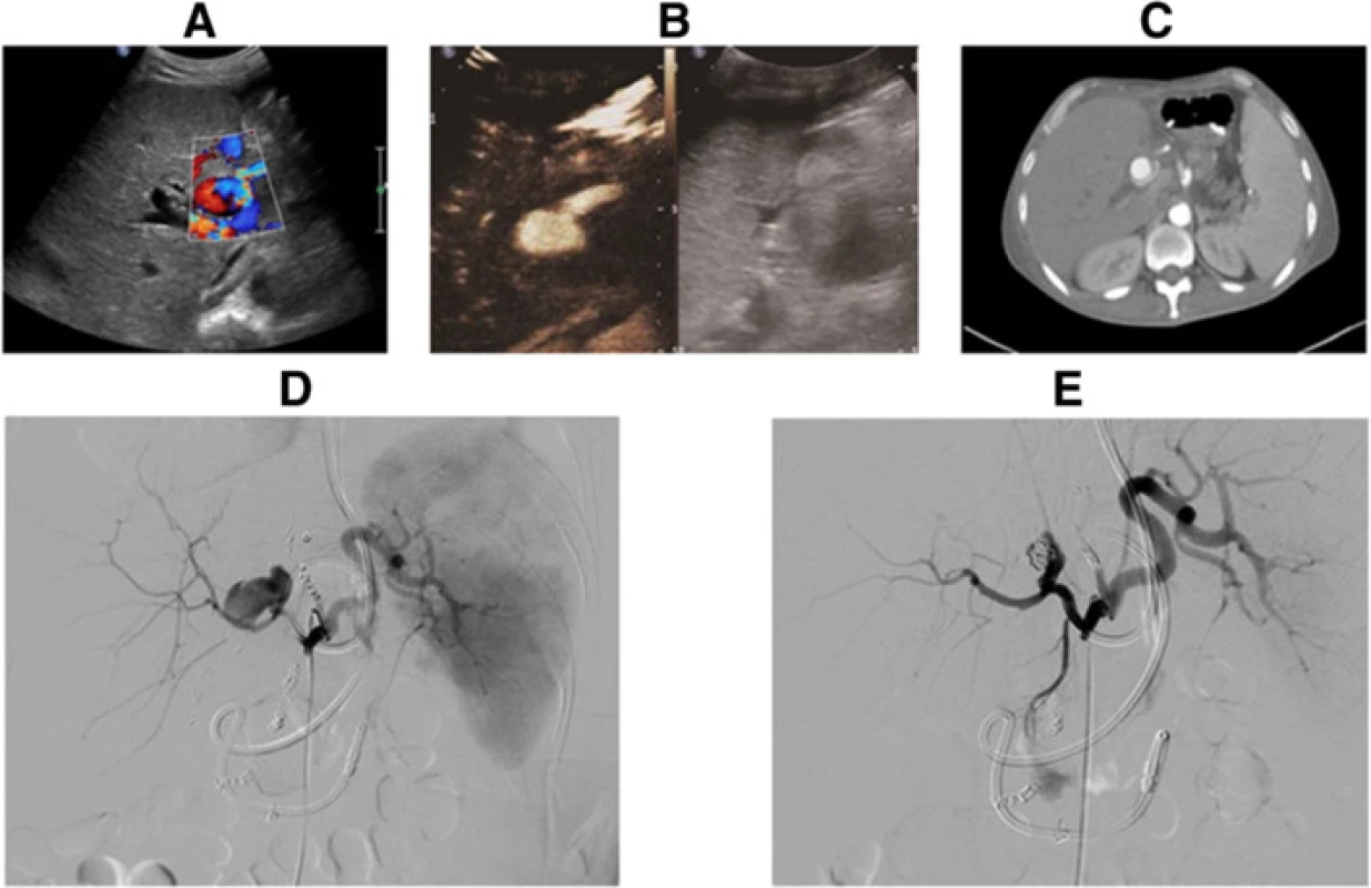 HAP was identified by (a) Color Doppler ultrasound, b CEUS and c Contrast-enhanced CT (&lt;i&gt;arrow&lt;/i&gt;), and confirmed by (d) DSA. e The patient underwent coil embolization combined with thrombin injections, and the lumen of the pseudoaneurysm was totally occluded, which was confirmed by DSA