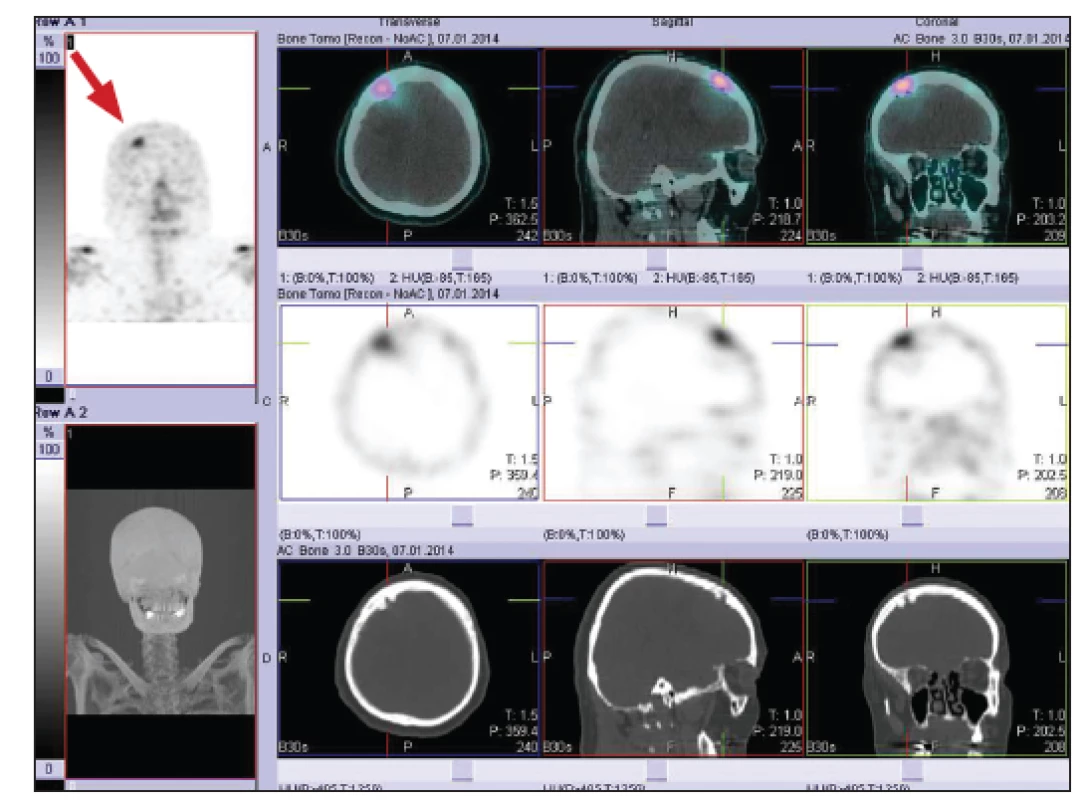 SPECT/CT hlavy. Scintigraficky je patrná zvýšená osteoblastická aktivita frontálně vpravo. V CT obraze je defekt ve skeletu kalvy s fokálním rozší řením skeletu.