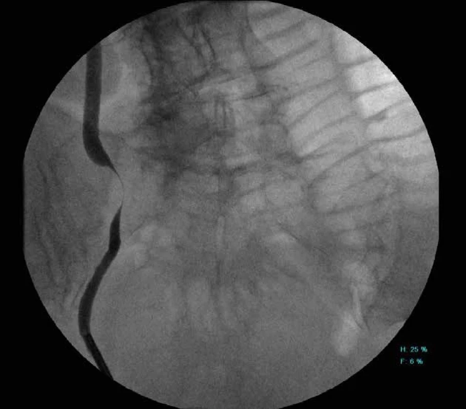 Perioperační skia snímek při stentáži ureteru   Fig. 3: Perioperative skiagram of ureteral stenting