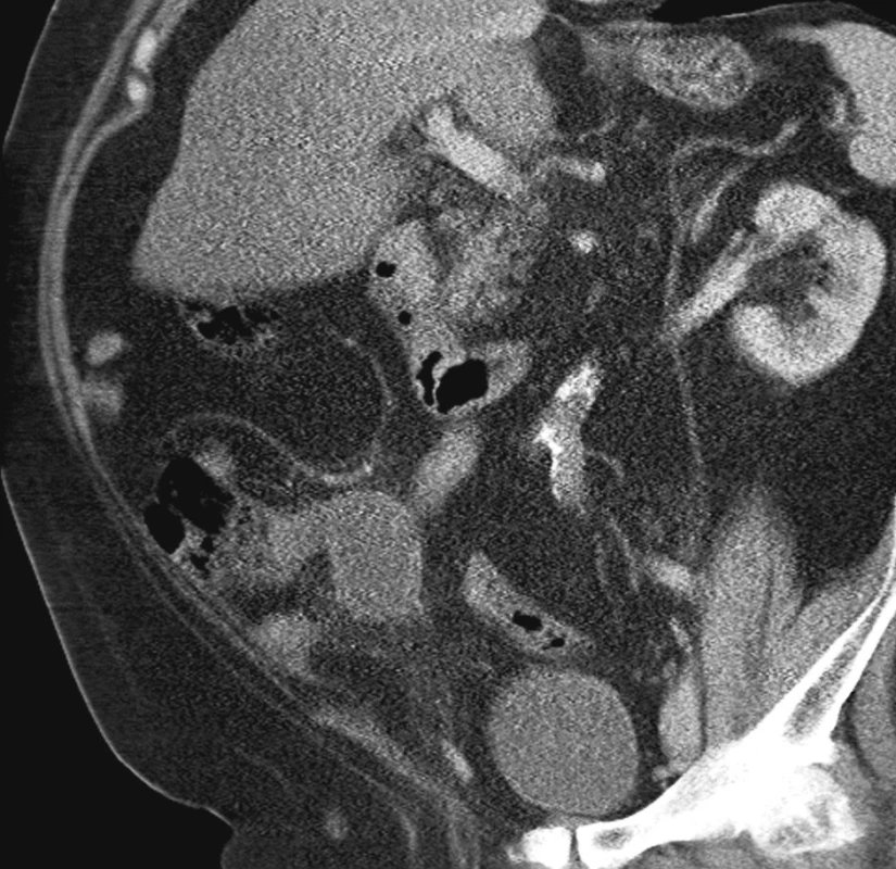 CT vyšetření břicha při příjmu
Fig. 1. Abdominal CT examination on admission