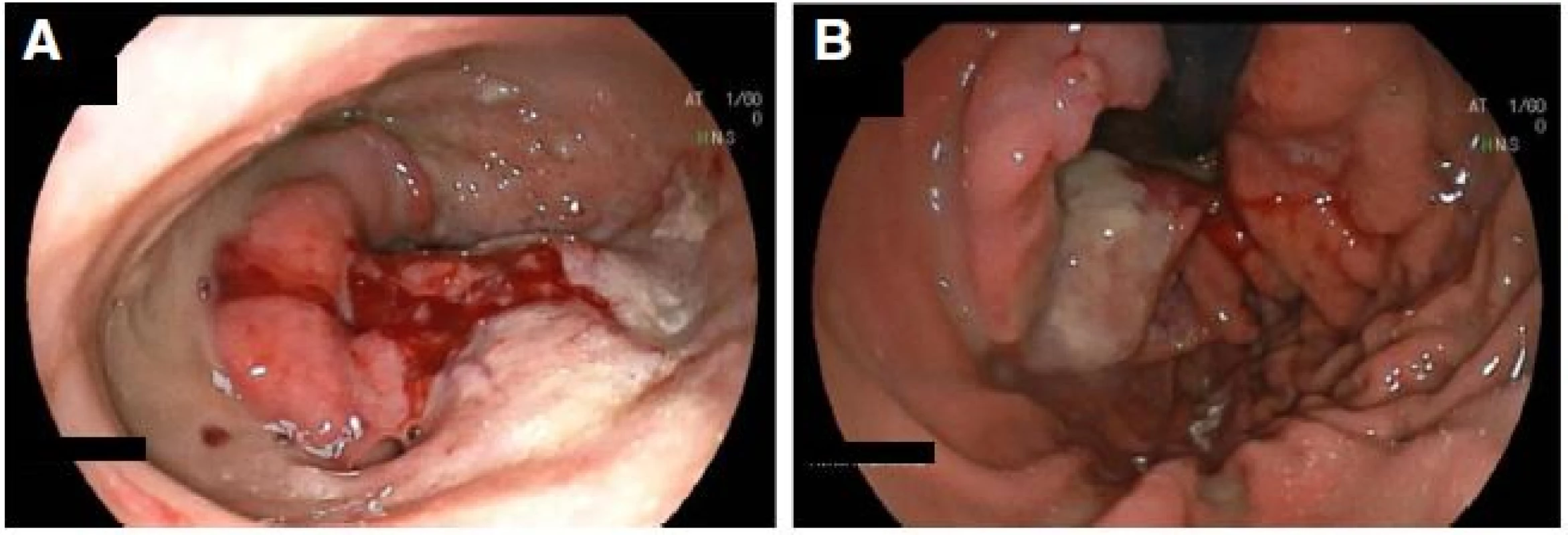 Gastroscopy showing a ulcerating mass within a hiatus hernia, and b view on endoscopic retroversion