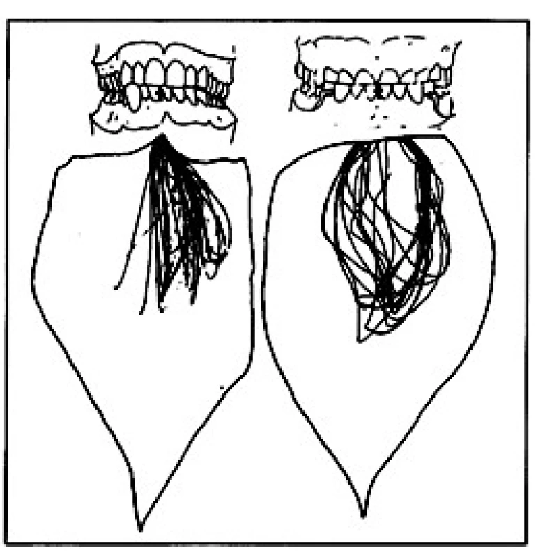 Záznam žvýkacích pohybů a hraničních pohybů dvou dospělých s různým typem žvýkání ve frontální rovině. Vlevo – vertikální vzorec žvýkání, vpravo – horizontální vzorec žvýkání. (Obrázek převzat z knihy Mohl, N. D., Zarb, G. A., Carlsson, G. E., Rugh, J. D.: A textbook of occlusion. Quintessence Publishing, 1988. ISBN 0-86715-167-6 [8].)
