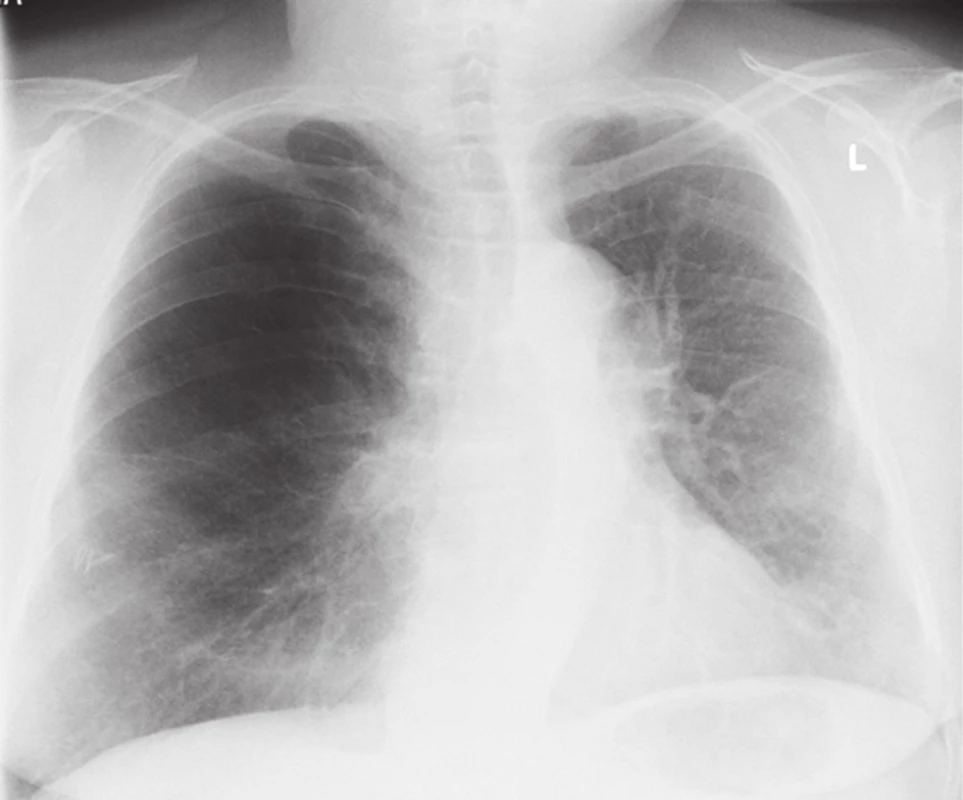RTG po primotransplantaci
Fig. 1. Chest X-ray after primary transplantation