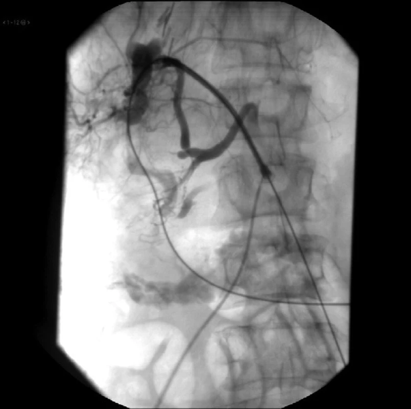 Poranenie vnútropečeňovej tepny – arteria hepatica sinistra
Fig. 5: Injury of intrahepatic artery – left hepatic artery