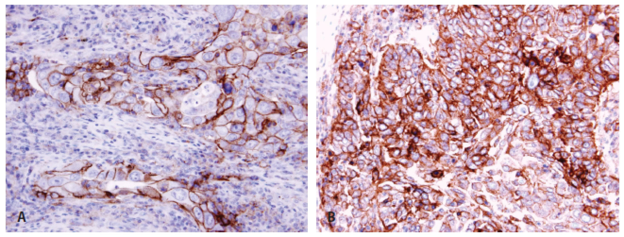 Pozitivita PD-L1 u plicního adenokarcinomu &lt;b&gt;(A)&lt;/b&gt; a dlaždicobuněčného karcinomu &lt;b&gt;(B)&lt;/b&gt; imunohistochemicky protilátkou klonu 22C3.