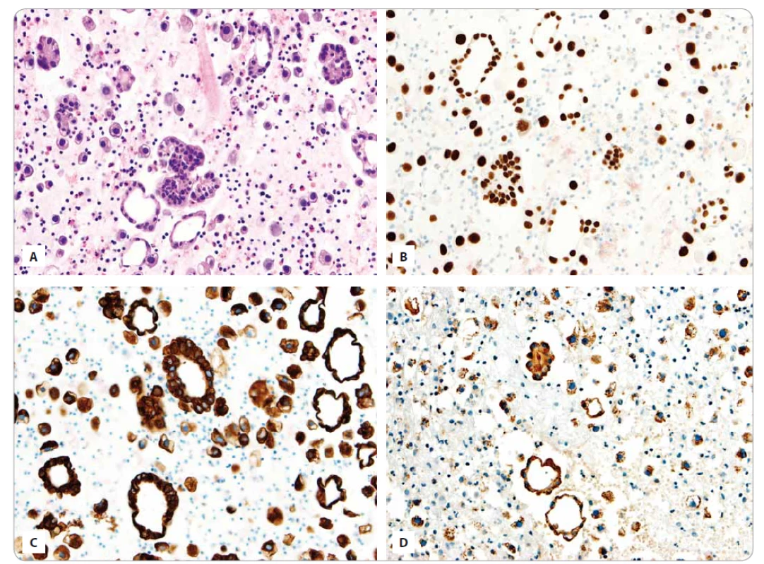 A. Výrazně buněčný řez z cytobloku s četnými buňkami adenokarcinomu plic buď jednotlivými nebo tvořícími dilatované tubulární a papilární struktury (barvení hematoxylin eozin).
B. Imunohistochemický průkaz TTF 1 v buňkách plicního adenokarcinomu.
C. Imunohistochemický průkaz cytokeratinu 7 v buňkách plicního adenokarcinomu.
D. Imunohistochemický průkaz napsinu A v buňkách plicního adenokarcinomu.