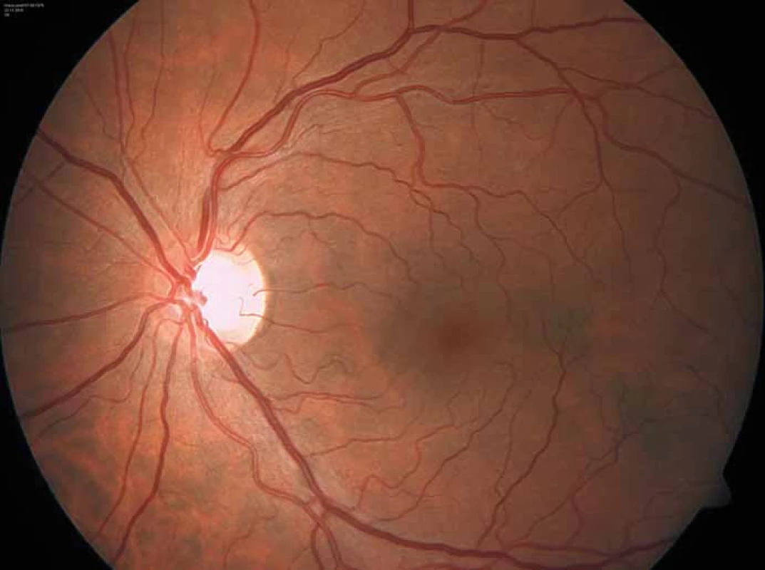 Charakteristicky vinuté retinální cévy u pacienta s Fabryho chorobou.
Fig. 7. Characteristic tortuous retinal vessels in a Fabry disease patient.