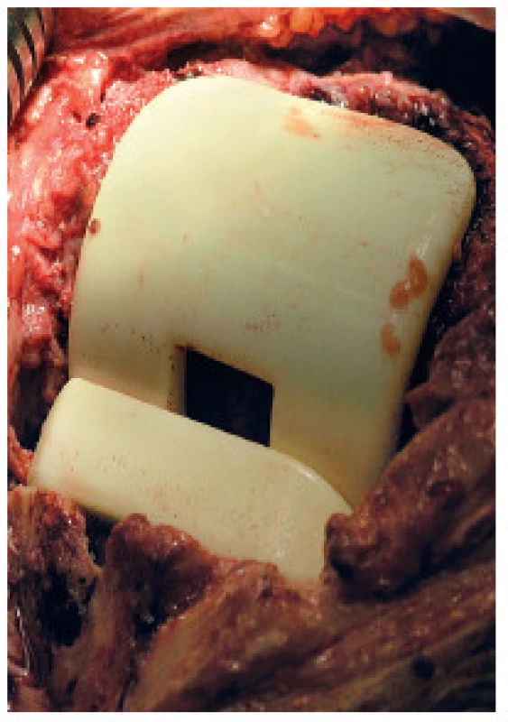 Peroperační snímek implantovaného kolenního spaceru Synicem&lt;sup&gt;®&lt;/sup&gt;
Fig 2. Perioperative photo of an implanted Synicem&lt;sup&gt;®&lt;/sup&gt; knee spacer