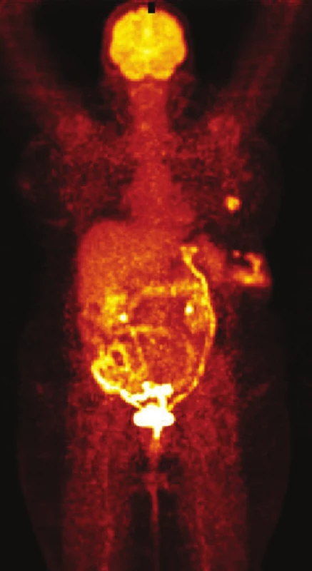 PET/CT Metastázy maligního melanomu v podkoží zad a levé axily
Fig. 5: PET/CT Malignant melanoma metastases to the subcutaneous tissue of the back and the left axilla