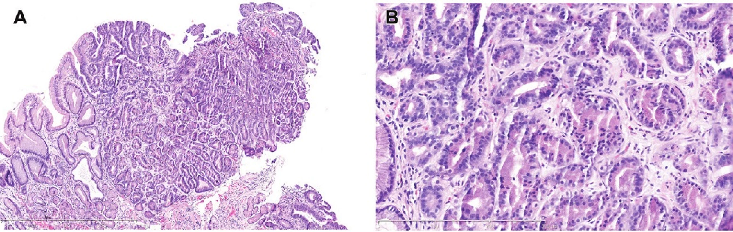 A. Dysplasia with chief cell differentiation. This unusual lesion has features of gastric lesions believed to have oxyntic or chief cell differentiation with deep eosinophilic cytoplasm and small round basal nuclei. Note, however, that the surface has stratified nuclei like those in intestinal type dysplasia.H&amp;E (40x). B. Dysplasia with chief cell differentiation. Note the angulated tubules, many containing cells with grey cytoplasm like that found in the chief cells of oxyntic mucosa. H&amp;E (200x).