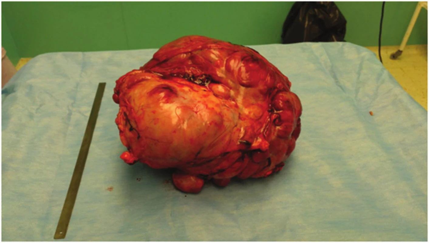 Extirpovaný tumor
Fig. 6: Resected tumor