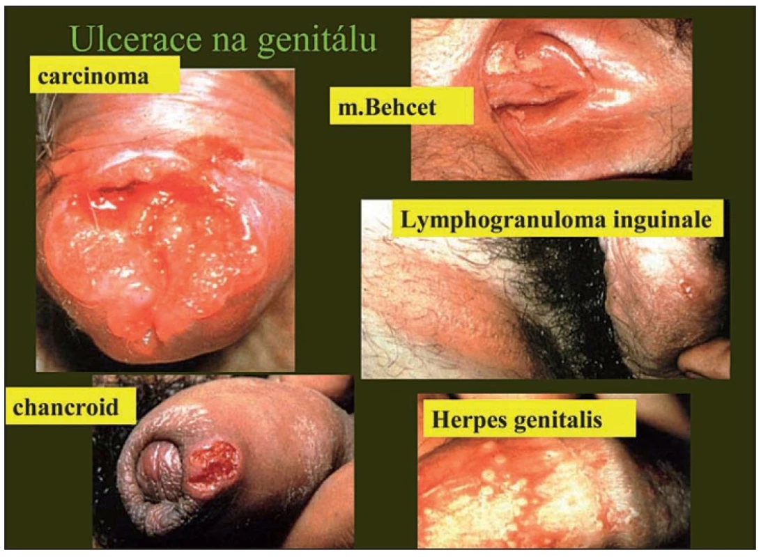 Klinické srovnání některých vředů na genitálu