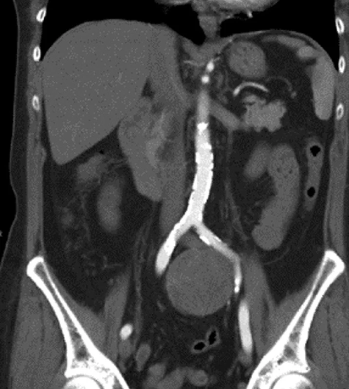 Schwannom v bifurkaci aorty (CT)
Fig. 1: Schwannoma in the aortic bifurcation