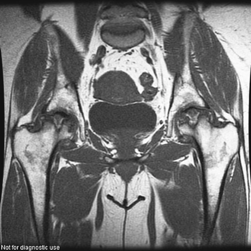 Kyčelní klouby (T1W obraz ve frontální rovině). Pokročilá osteonekróza hlavic femuru postihující oboustranně v celém rozsahu horní části hlavic s jejich oploštěním.
