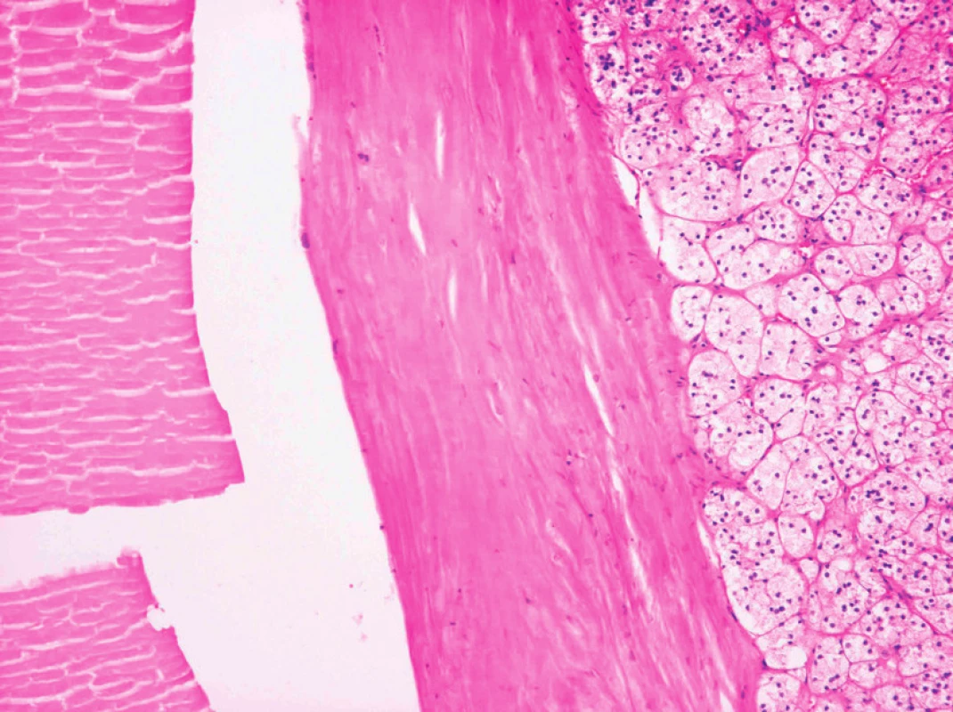 Stěna cysty vystlaná endotelem, 100× zvětšeno, barveni hematoxylin eosin, vpravo viditelná tkáň nadledviny
Fig. 4. Wall of the cyst lined by endothelial cells, 100× magnifi ed, hematoxylin eosin staining, adrenal gland tissue visible on the right