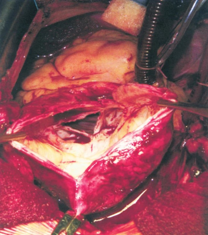 Pohled na aortální chlopeň (trojcípá, ztluštěná, centrální otvor způsobující regurgitaci)
Fig. 2. View of the aortic valve (the tricuspid, thickened, the central opening causing regurgitation)