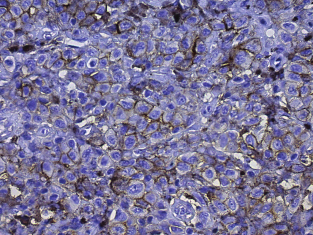 Pozitivita CD166, membránová pozitivita v buňkách melanomu
