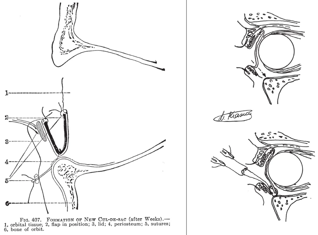 Chirurgické techniky
A – operace cul-de-sac podle Weekse (převzato z Fuchs, H.E. &amp; Duane, A.: Text-Book of Ophthalmology, 1923)
B – schéma operace: řez na hranu očnice (nahoře) a fixační stehy do periostu (dole)