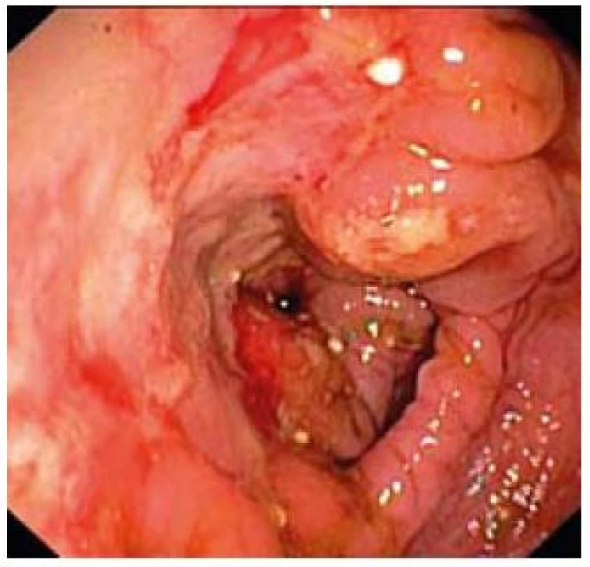 Edém, ulcerácie, kontaktné krvácanie sliznice colon transverzum.
Fig. 1. Swelling of mucosa, ulcerations, contact bleeding in colon transversum.