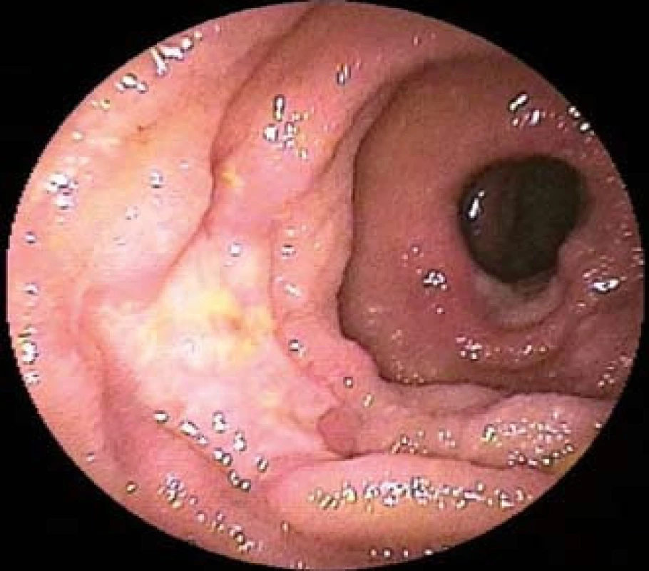 Difuzní velkobuněčný B-buněčný lymfom jejuna u 58letého pacienta s recentně diagnostikovanou celiakií. Dvojbalonová enteroskopie prokazuje mnohočetné ulcerace tenkého střeva.
Fig. 2. Diffuse large B-cell lymphoma of the jejunum of 58-year-old patient recently diagnosed with celiac disease. Double-balloon enteroscopy shows multiple ulcers of the small intestine.