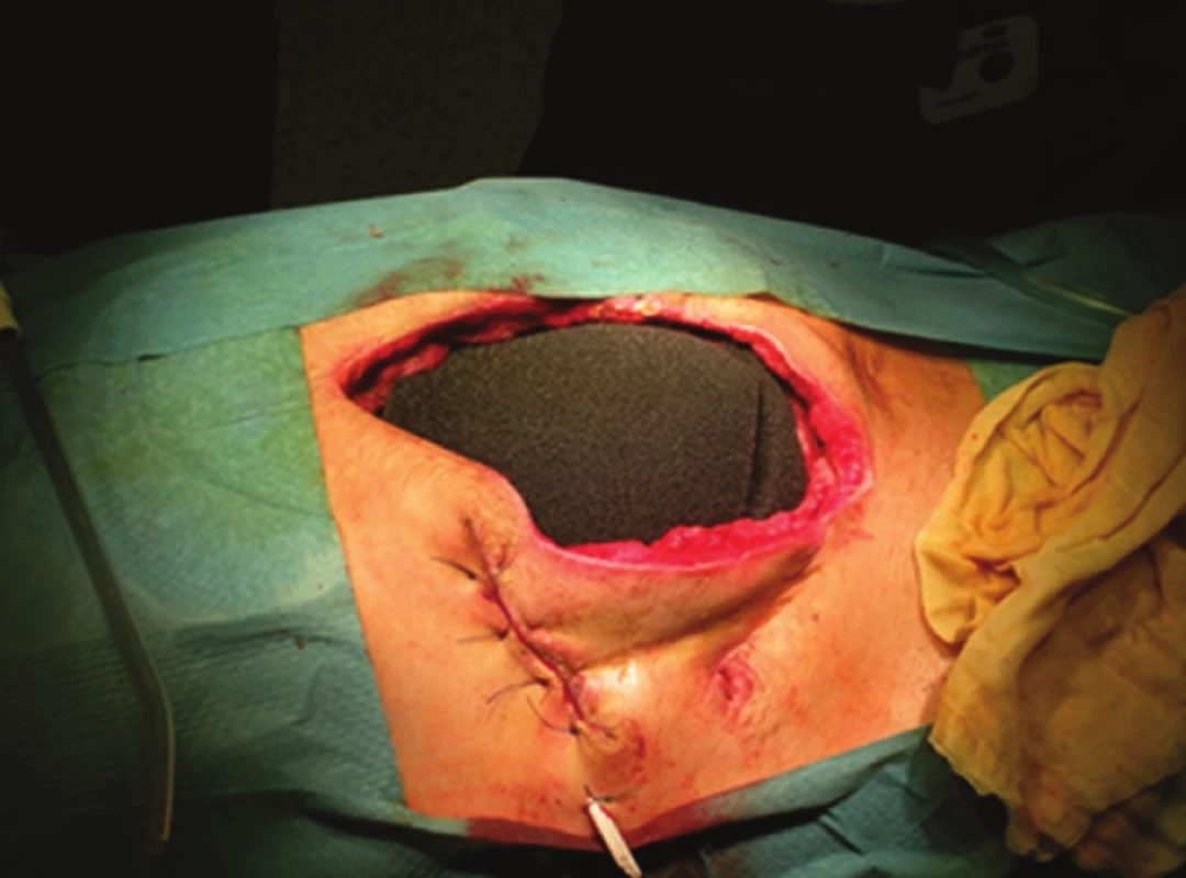Vnitřní vrstva laparostomie
Fig. 2: The inner layer of TNP laparostomy