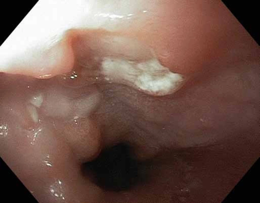 Typický vřed jícnu vzhledu sopky.
Fig. 1. Typical esophageal ulcer with volcano-like appearance.