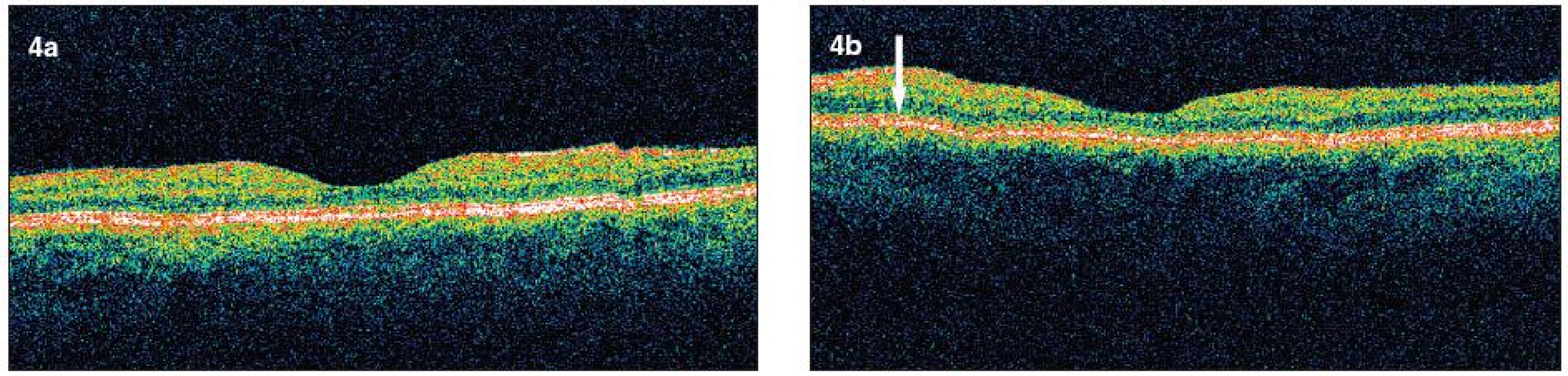 a, b. Horizontálne skeny obraz pravého a ľavého oka ( OCT III Stratus Zeiss) po 6 týždňoch vidno vymiznutie masívneho opuchu sietnice, vytvorenie foveolárnej depresie. Pretrváva diskrétny opuch vo vonkajšej i vnútornej plexiformnej vrstve – hyporeflektívne cystické oblasti, výraznejší opuch je v peripapilárnej oblasti, vľavo v mieste vstrebávajúcich sa vatovitých ložísk ešte zhrubnutie vrstvy nervových vlákien