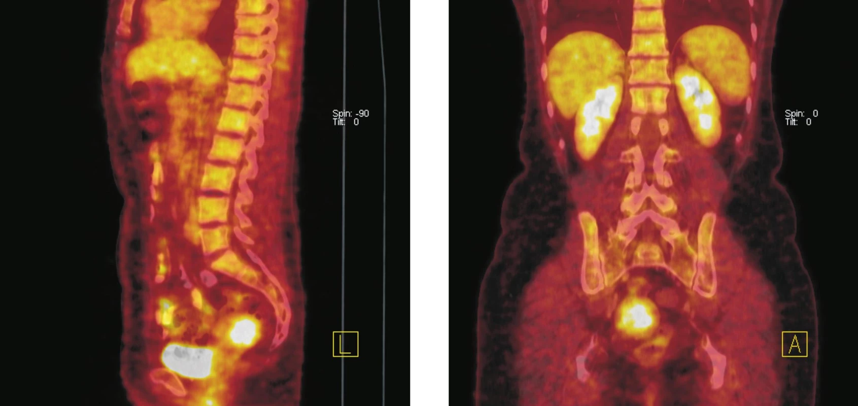 Fúze PET a CT řezů–sagitální rovina (vlevo), koronální rovina (vpravo). Ve fundu dělohy lze na CT diferencovat hyperdenzní formaci o průměru 36 mm se zvýšenou akumulací &lt;sup&gt;18&lt;/sup&gt;F-FDG. Po srovnání klinických a ultrazvukových nálezů z posledních 5 let (gynekolog) a vstupního CT vyšetření bylo konstatováno, že se jedná o stacionární leiomyom děložního těla. Kontrolní &lt;sup&gt;18&lt;/sup&gt;F-FDG PET/CT vyšetření o rok později potvrdilo neměnnost nálezu.
