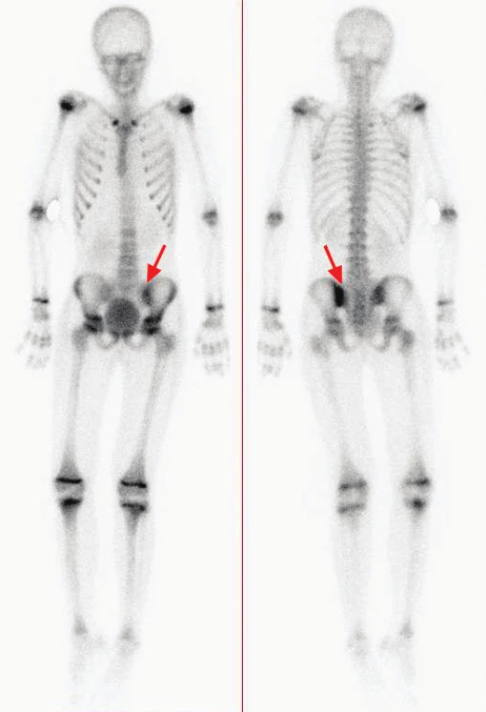 (vpravo) Celotělová scintigrafie s nálezem patologicky zvýšené akumulace &lt;sup&gt;99m&lt;/sup&gt;Tc-HDP v levém sakroiliakálním skloubení a fyziologicky v růstových zónách dlouhých kostí.